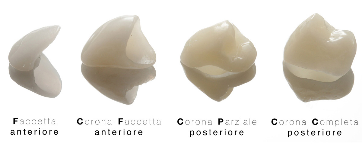 Faccette e Corone dentali