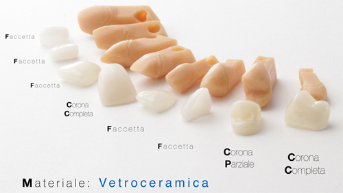 Faccette in vetroceramica