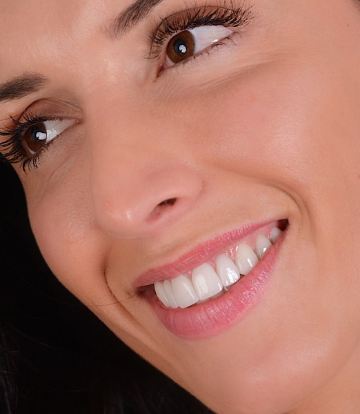 Migliorare sorricso con faccette dentali