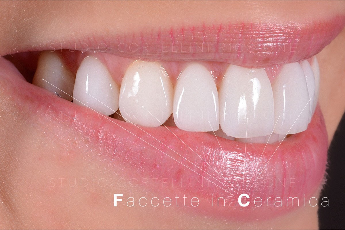 Nuovo sorriso con le faccette dentali - Studio Cortellini Riccione