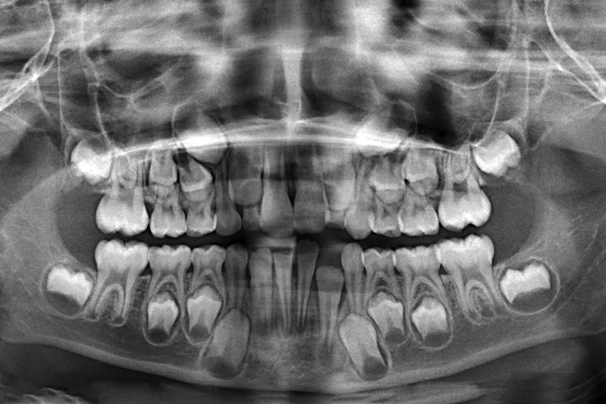 Radiografia denti normale di un bambino di 8 anni