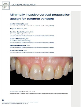 MINIMALLY INVASIVE VERTICAL PREPARATION DESIGN FOR CERAMIC VENEERS